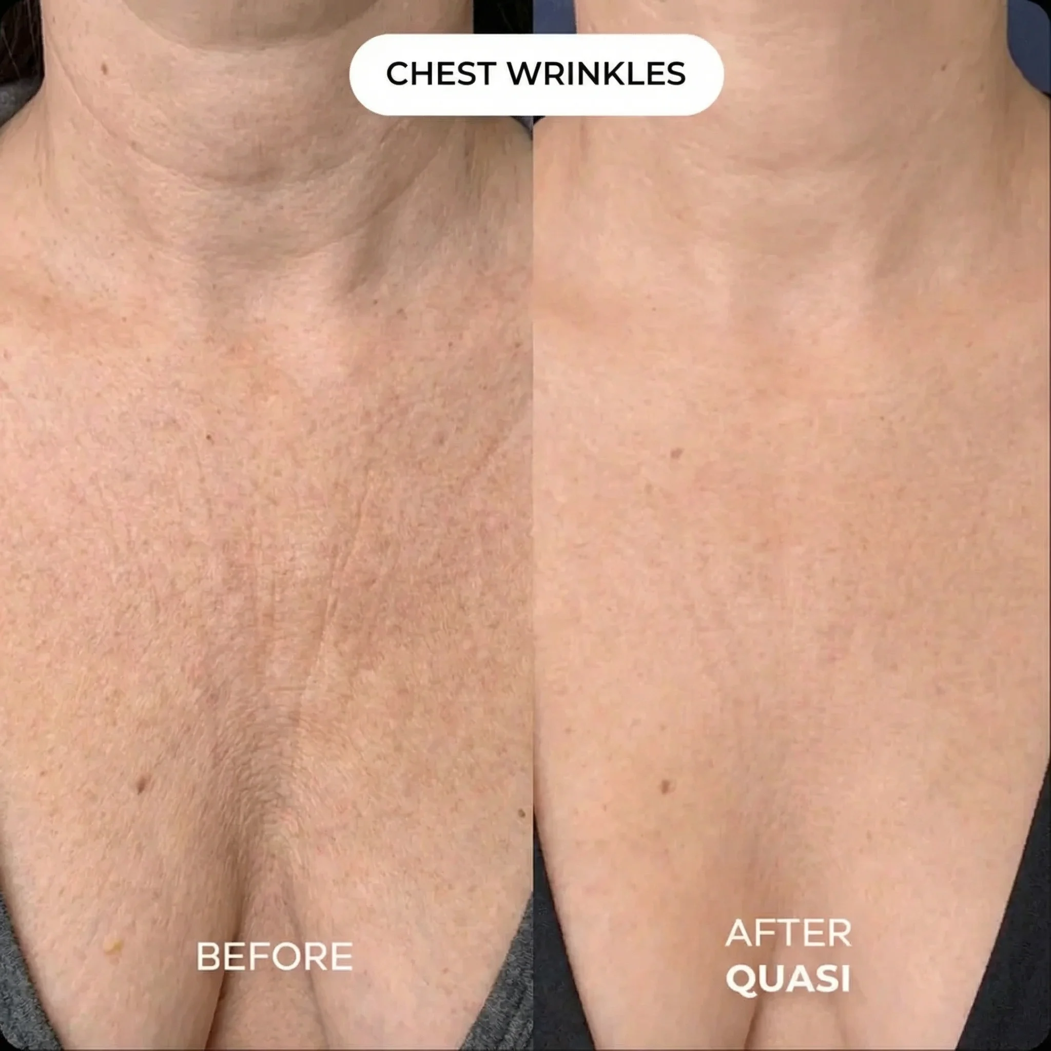 Collagen Chest Mask - Image 4