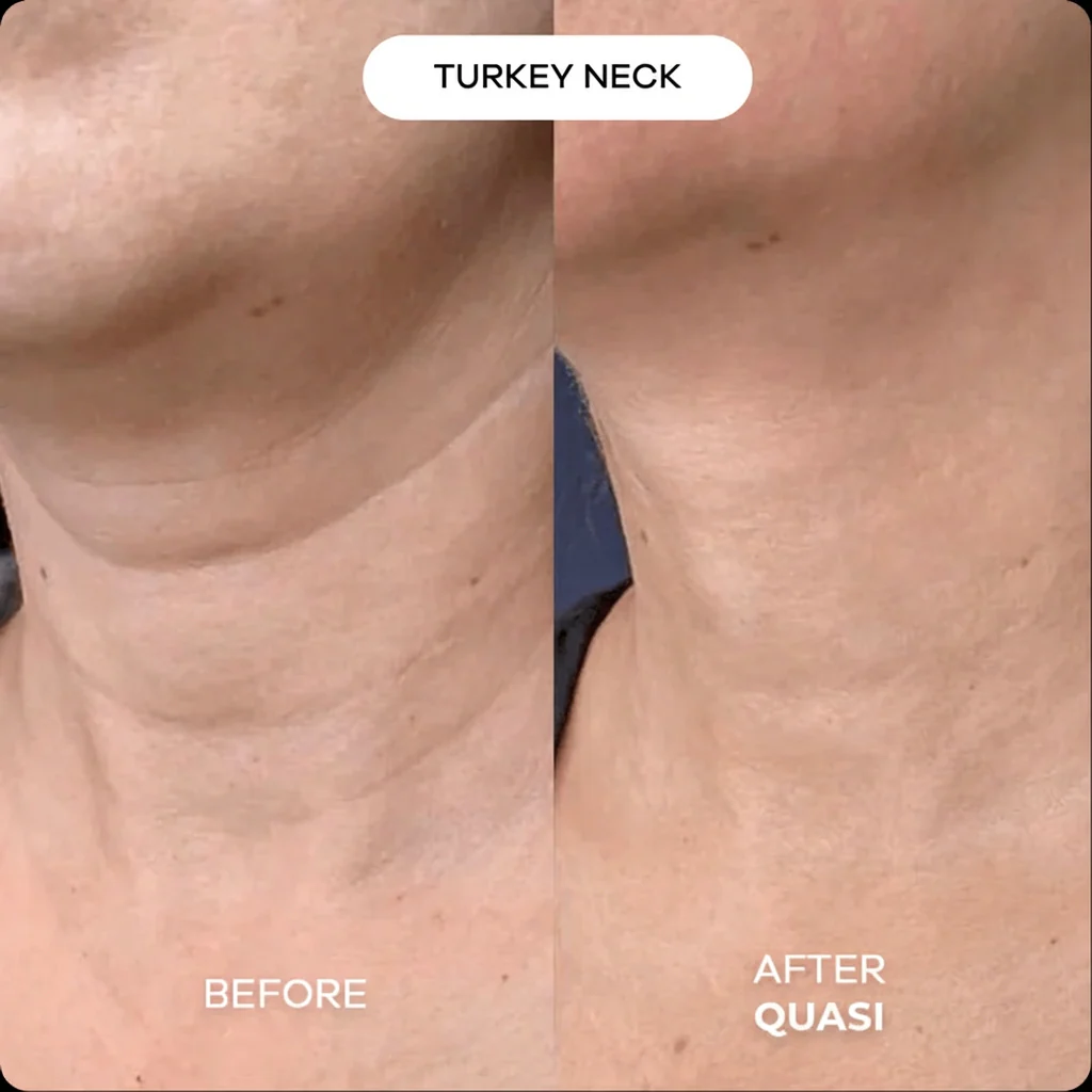 Collagen Neck Mask - Image 4